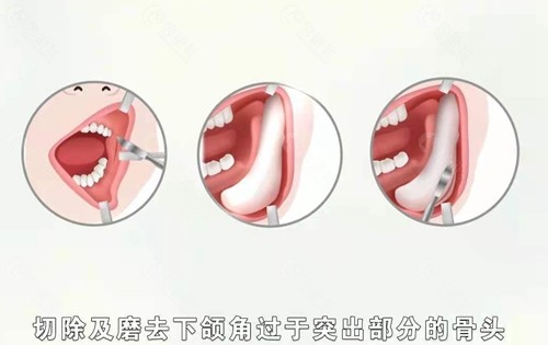 下颌角截骨手术方法