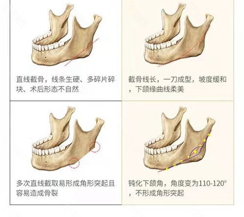 下颌角截骨后骨头的变化