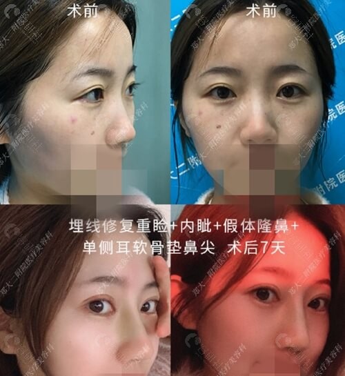 郑州大学第二附属医院整形科耳软骨隆鼻术后效果