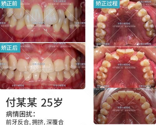 呼和浩特华医口腔牙齿矫正对比照