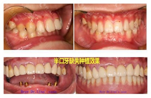 上海拜博（拜尔）口腔牙齿矫正和半口种植前后对比照片