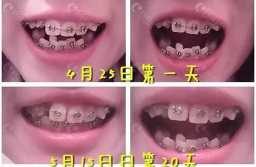 北京中诺口腔矫正前后牙齿变化图