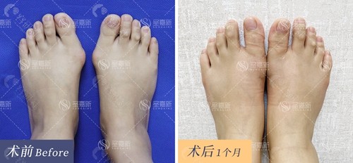 北京圣嘉新医疗美容医院苏敬达大脚骨矫正前后对比图
