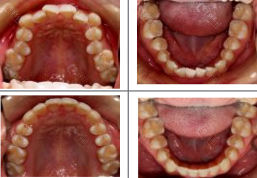 北京佳美口腔牙齿矫正前后对比照