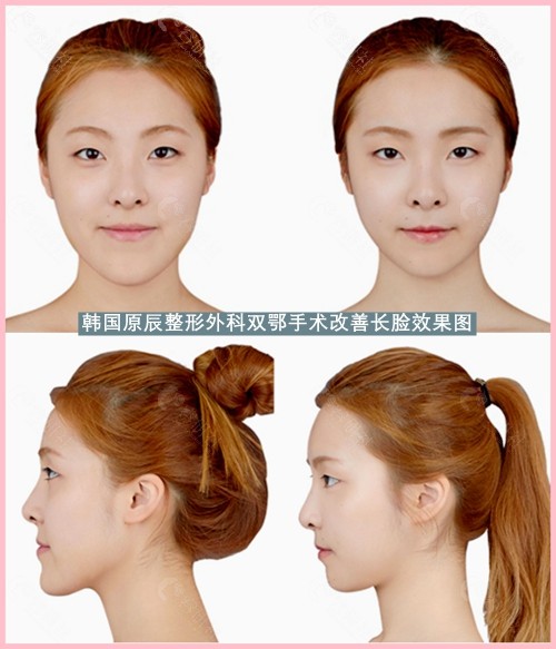 韩国原辰整形外科双鄂手术改善长脸实例
