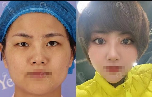 武汉艺星医疗美容医院做双眼皮对比图