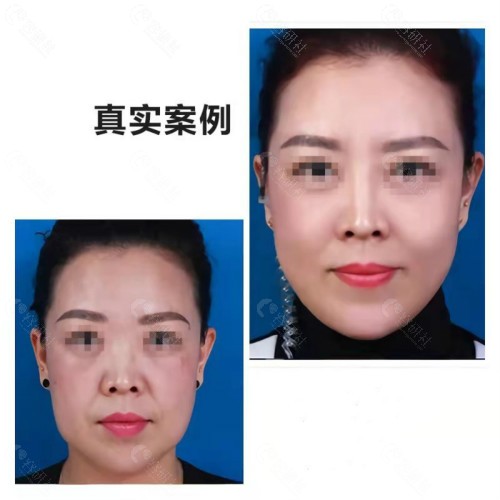 福州名韩整形美容面部提升对比照