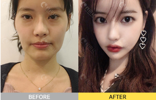 韩国珠儿丽下颌角手术前后对比照
