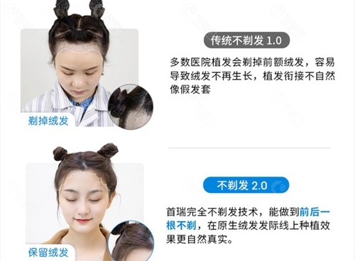 杭州首瑞植发的不剃发植发和传统植发的区别
