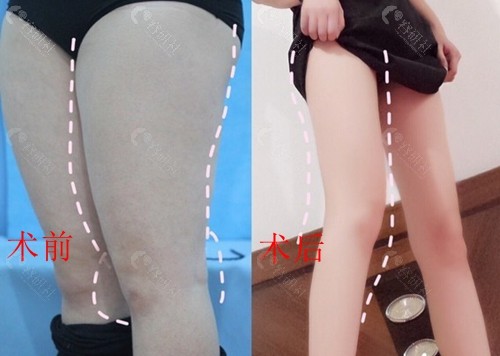 苏州维多利亚医疗美容医院大腿吸脂术前术后对比效果图