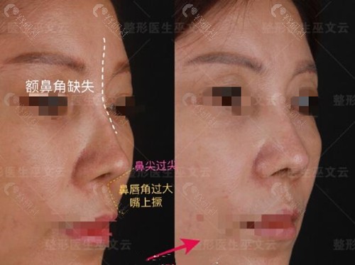 北京米扬丽巫文云鼻修复术前术后对比