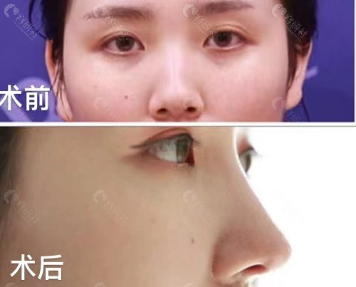 杭州艺星医疗美容医院徐利刚院长对比图