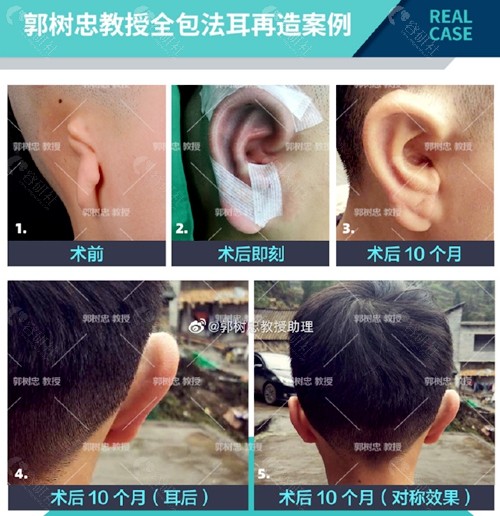 郭树忠教授全包法耳再造术后10个月效果图