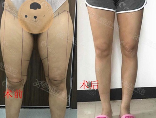 广州军美医疗美容大腿吸脂术前术后对比效果图分享