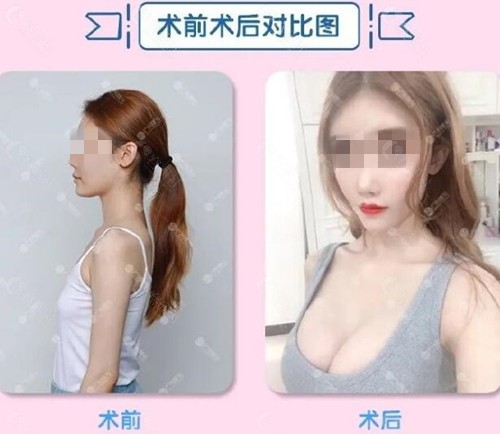 广州曙光医学美容医院假体隆胸前后对比图