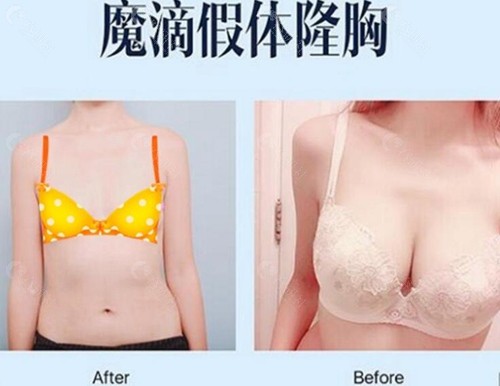 韩国普罗菲耳整形医院魔滴假体隆胸前后对比图