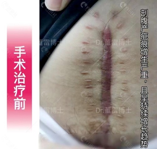 上海清沁剖腹产疤痕增生治疗术前