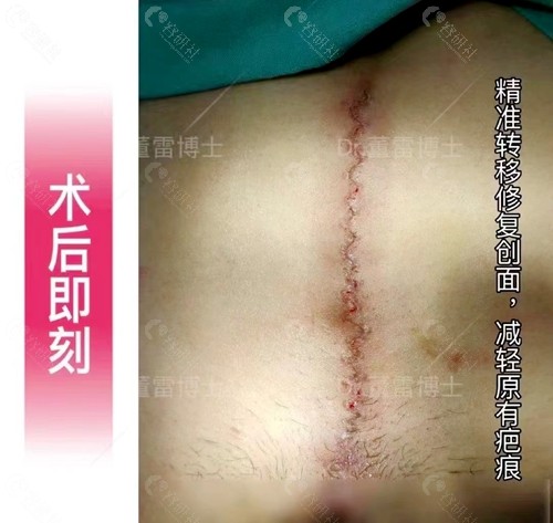上海清沁剖腹产疤痕增生修复术后即刻