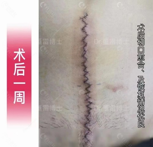 上海清沁董雷博士剖腹产疤痕增生修复术后7天