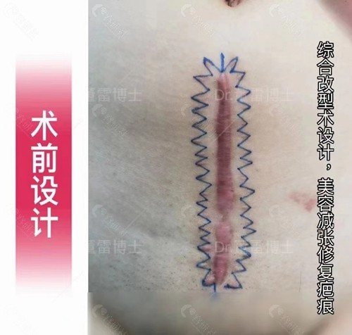 上海清沁剖腹产疤痕增生修复术前设计