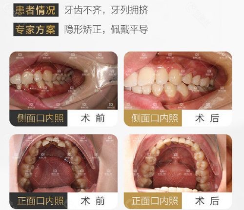 南昌德韩口腔牙齿矫正对比照