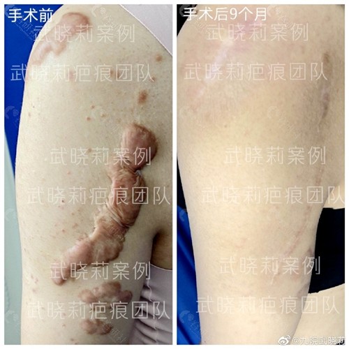 上海九院武晓莉身体疤痕疙瘩手术综合治疗前后对比图