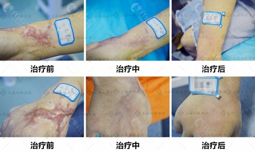 上海虹桥疤痕修复治疗前后对比图