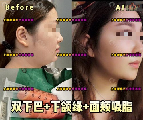 上海薇琳双下巴+下颌缘+面部吸脂效果图