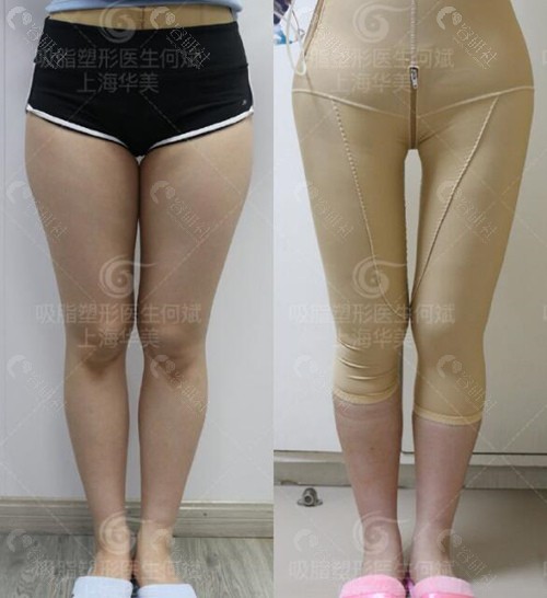 上海华美大腿吸脂术前术后对比