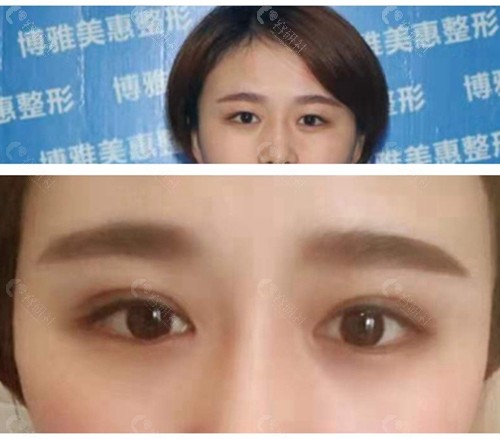 台州博雅美惠割双眼皮前后对比照片