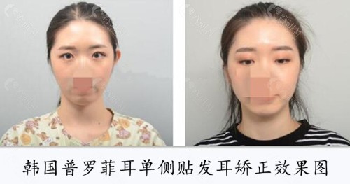 韩国普罗菲耳单侧贴发耳矫正真人前后对比图