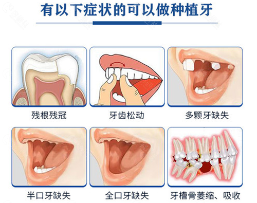 做种植牙的几种情况