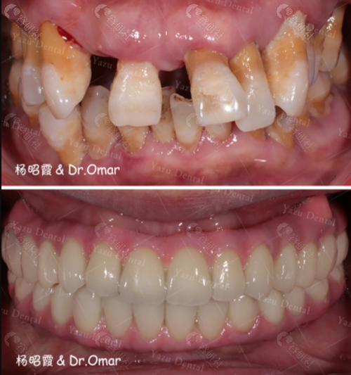 种植牙前后对比照