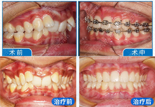 北海蓝天口腔医院牙齿矫正对比照