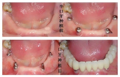南京美奥口腔半口种植前后对比照片