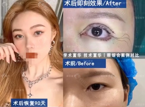 深圳富华医疗美容医院割双眼皮术前术后对比效果分享