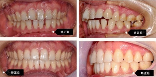江西南昌维乐口腔牙齿矫正术前术后对比