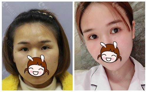 上海玫瑰双眼皮手术对比照
