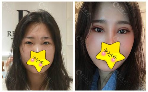 上海薇琳双眼皮手术对比照