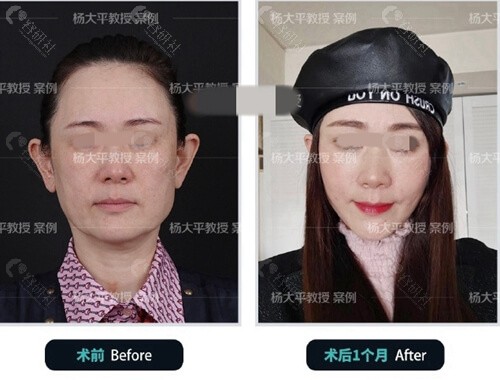 北京联合丽格医疗美容面部提升术后一个月<span style=