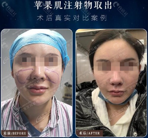 北京艾玛李方奇注射物取出术前术后对比