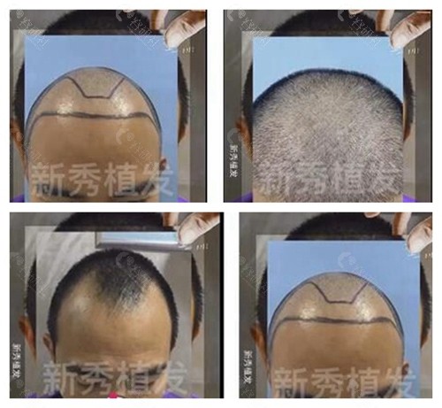 南京新秀植发发际线种植前后对比照片