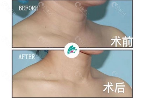 北京延世医疗美容医院嗨体去颈纹前后对比照