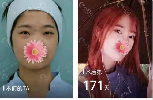 上海九院割双眼皮对比照
