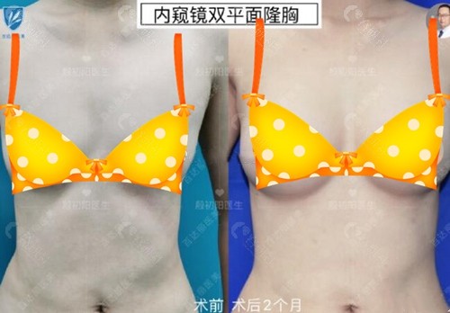 上海百达丽殷初阳曼托假体隆胸术前术后对比