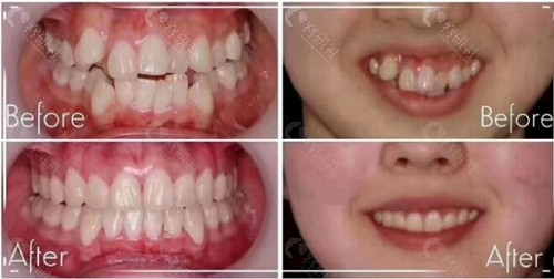 深圳麦芽口腔牙齿矫正术前术后对比