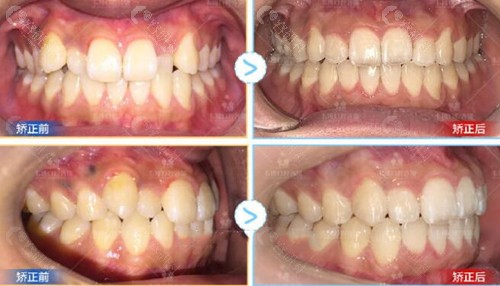 深圳韦博口腔牙齿矫正术前术后对比