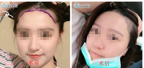 广州碧莲盛植发发际线种植术前术后对比效果图