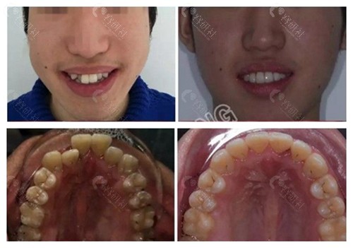 杭州雅莱口腔牙齿矫正前后对比照片