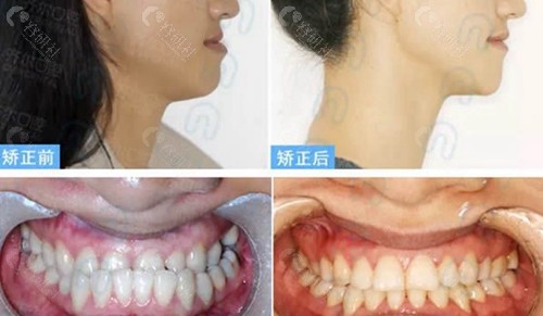 杭州齐尔口腔牙齿正畸前后对比照片